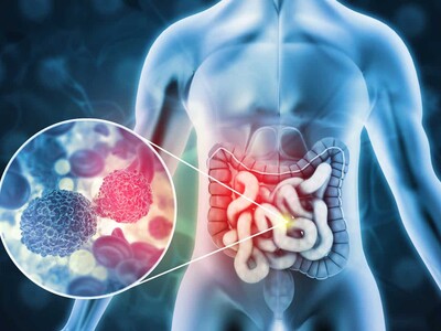 El 10 % del cáncer de colon se presenta antes de los 50 años