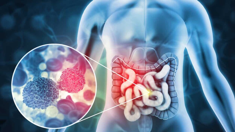 El 10 % de los diagnósticos de cáncer de colon se hacen antes del paciente cumplir 50 años El 10 % de los diagnósticos de cáncer de colon se hacen antes del paciente cumplir 50 años