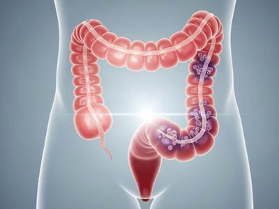 Llaman a mayores de 45 a chequeos para prevenir cáncer de colon
