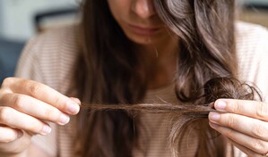 M&aacute;s all&aacute; de la ca&iacute;da: lo que debes saber sobre la calvicie femenina