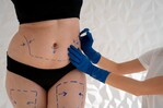 ¿Es seguro realizarse varios procedimientos estéticos en una sola cirugía? ¿Es seguro realizarse varios procedimientos estéticos en una sola cirugía?