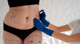 &iquest;Es seguro realizarse varios procedimientos est&eacute;ticos en una sola cirug&iacute;a?