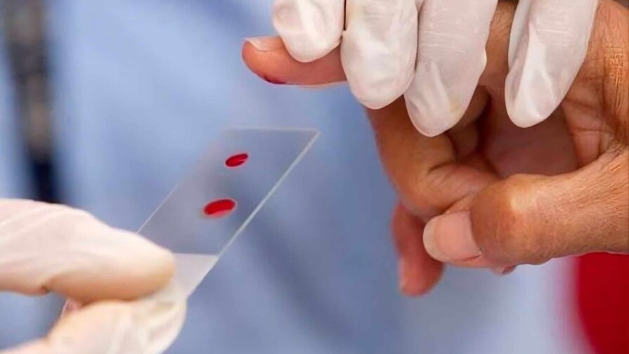 Estiman que m&aacute;s de 570 dominicanos viven con hemofilia