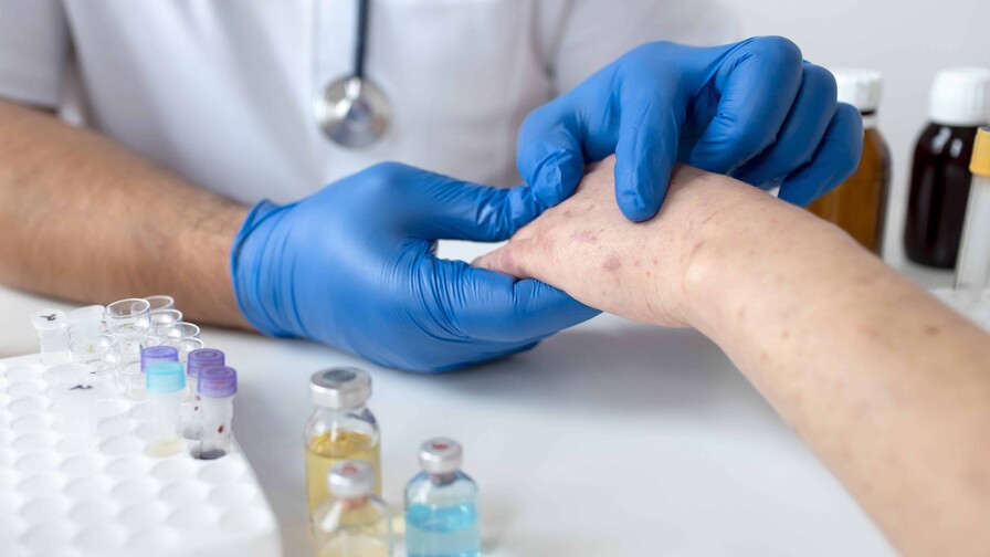 OPS advierte del aumento de casos de sarampi&oacute;n en las Am&eacute;ricas