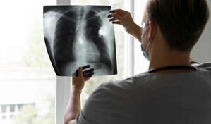 La nueva era del diagn&oacute;stico temprano para el c&aacute;ncer de pulm&oacute;n