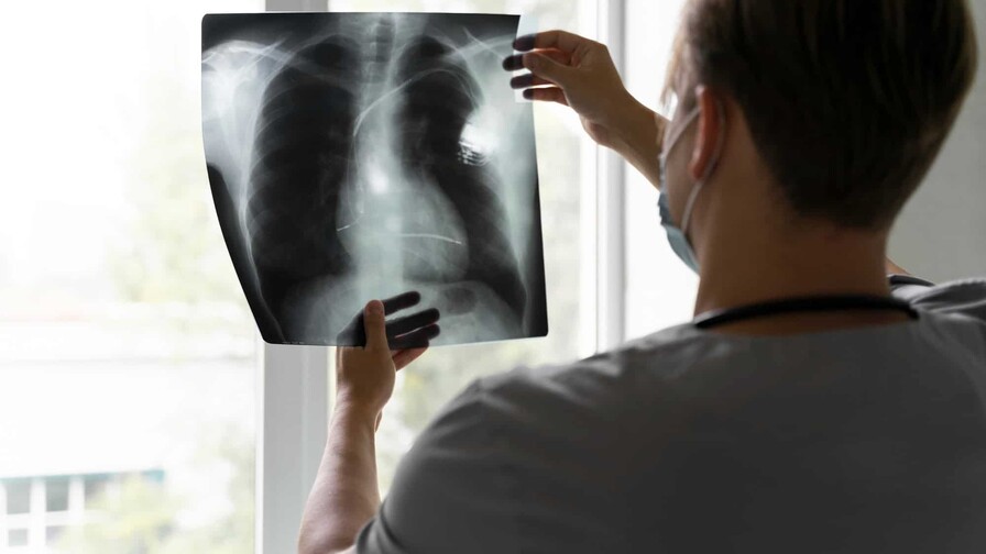 La nueva era del diagn&oacute;stico temprano para el c&aacute;ncer de pulm&oacute;n