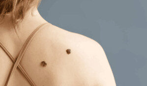 Melanoma: el c&aacute;ncer de piel que puede esconderse en un lunar