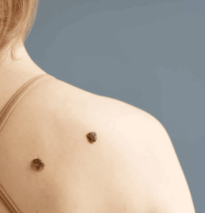 Melanoma: el c&aacute;ncer de piel que puede esconderse en un lunar
