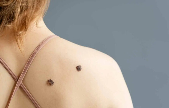 Melanoma: el c&aacute;ncer de piel que puede esconderse en un lunar