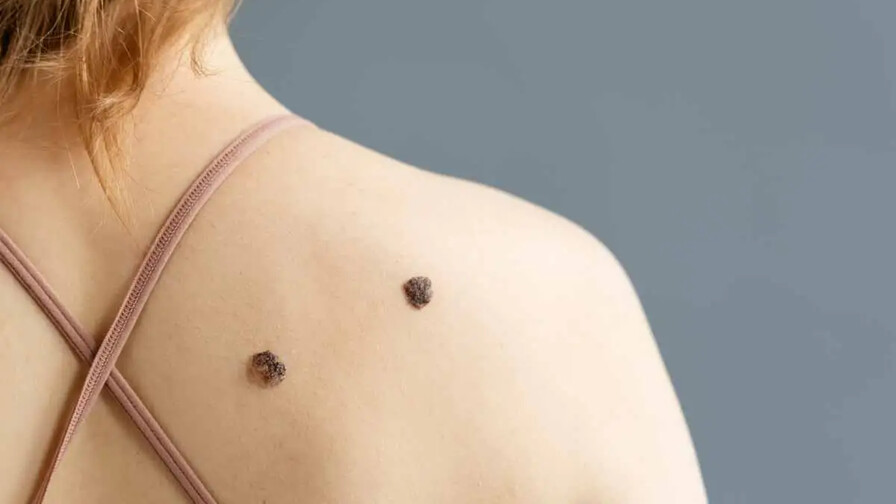 Melanoma: el c&aacute;ncer de piel que puede esconderse en un lunar