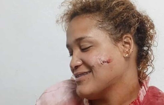 Violencia de pareja deja otra mujer herida en Puerto Plata