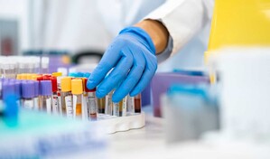Desarrollan un test para detectar el c&aacute;ncer de p&aacute;ncreas mediante una muestra de sangre