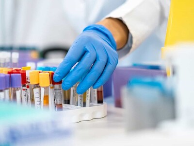 Cáncer de páncreas se podrá detectar a través de muestra de sangre