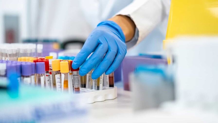 Desarrollan un test para detectar el cáncer de páncreas mediante una muestra de sangre Desarrollan un test para detectar el cáncer de páncreas mediante una muestra de sangre