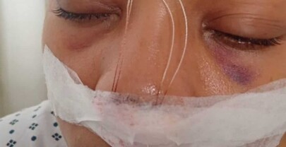 Denuncian mujer fue sometida a cirug&iacute;a tras brutal ataque de indigente en la autopista Duarte