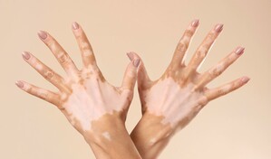 D&iacute;a Mundial del Vitiligo: Salud P&uacute;blica llama a combatir el estigma y promover la inclusi&oacute;n