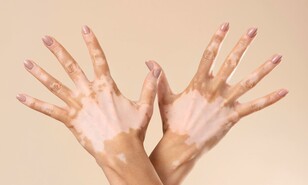 D&iacute;a Mundial del Vitiligo: Salud P&uacute;blica llama a combatir el estigma y promover la inclusi&oacute;n