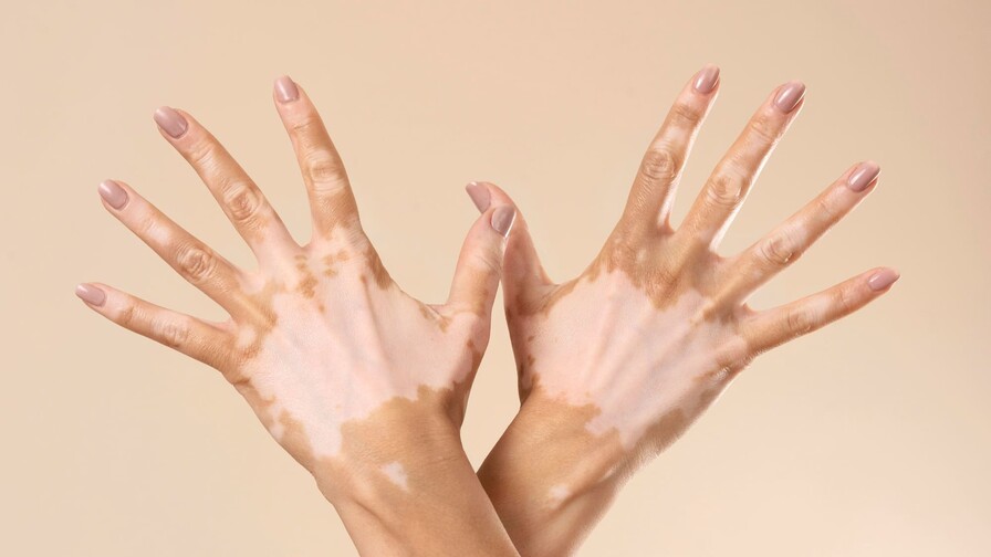 D&iacute;a Mundial del Vitiligo: Salud P&uacute;blica llama a combatir el estigma y promover la inclusi&oacute;n