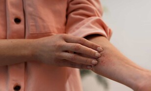 Dermatitis por calor: c&oacute;mo reconocerla y prevenirla