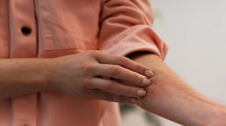 Dermatitis por calor: c&oacute;mo reconocerla y prevenirla