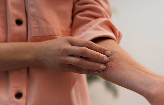 Dermatitis por calor: c&oacute;mo reconocerla y prevenirla