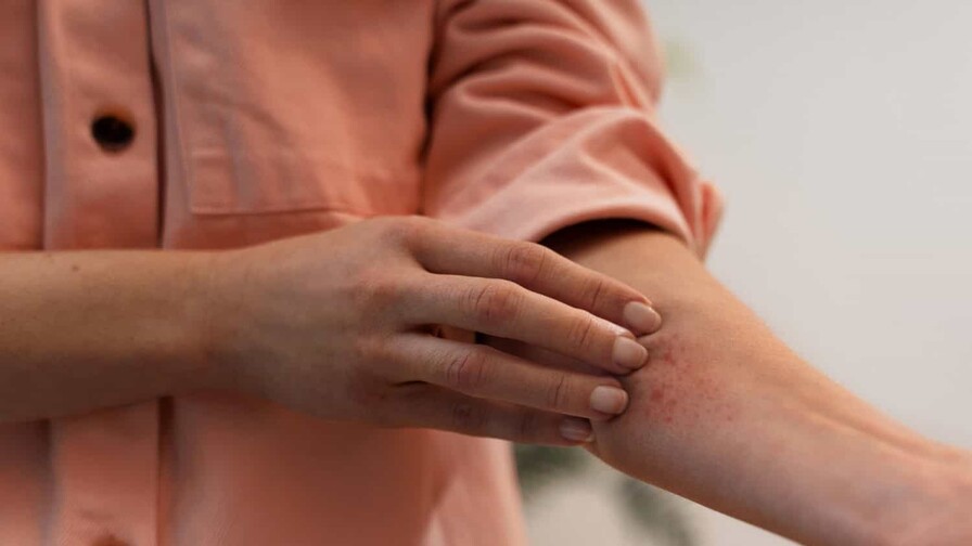 Dermatitis por calor: c&oacute;mo reconocerla y prevenirla