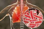 El brote de legionela en Nueva York deja 59 afectados y 15 hospitalizados