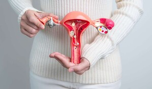 La endometriosis quiz&aacute;s no empiece en el &uacute;tero