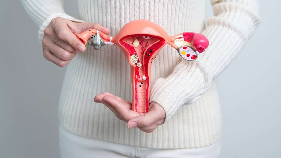 La endometriosis quizás no empiece en el útero La endometriosis quizás no empiece en el útero