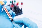 Detectan dos casos de viruela símica en un destacamento en San Cristóbal Detectan dos casos de viruela símica en un destacamento en San Cristóbal