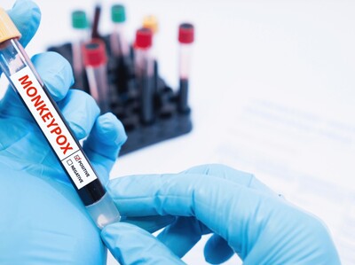 San Cristóbal reporta casos de mpox viruela símica