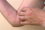 Viruela símica: qué es, cuáles son sus síntomas y cómo se transmite Viruela símica: qué es, cuáles son sus síntomas y cómo se transmite