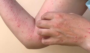 Viruela s&iacute;mica: qu&eacute; es, cu&aacute;les son sus s&iacute;ntomas y c&oacute;mo se transmite