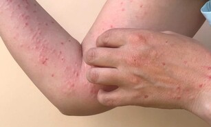 Viruela s&iacute;mica: qu&eacute; es, cu&aacute;les son sus s&iacute;ntomas y c&oacute;mo se transmite