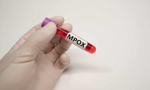 Qu&eacute; pasa con la Viruela S&iacute;mica (MPox) en la Rep&uacute;blica Dominicana