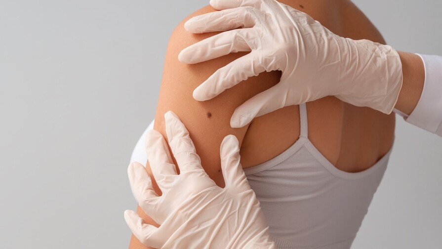 Moderna y Merck anuncian resultados positivos de una vacuna contra el c&aacute;ncer de piel