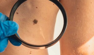 Cuba desarrolla tratamiento para el c&aacute;ncer de piel, en medio de la crisis de medicamentos