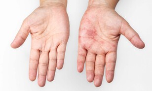 Vacuna recombinante contra el herpes z&oacute;ster