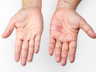 Shingles vaccine Shingrix linked to lower Alzheimer's risk