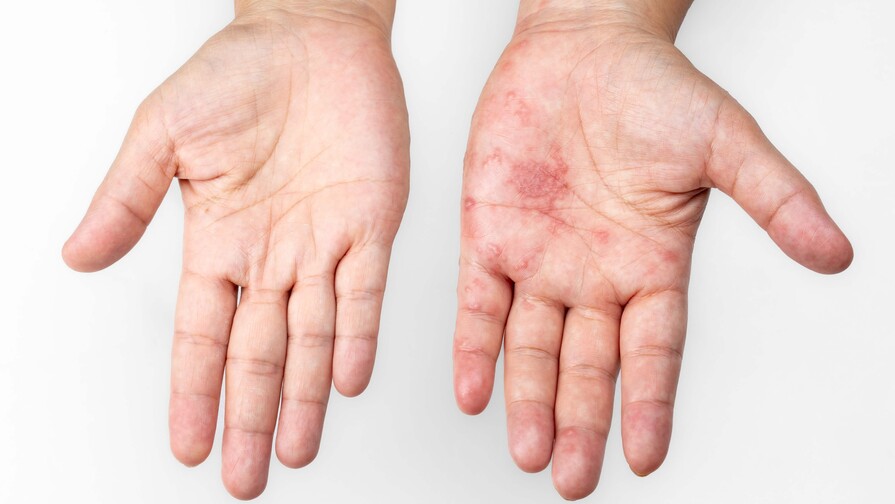 Vacuna recombinante contra el herpes zóster Vacuna recombinante contra el herpes zóster