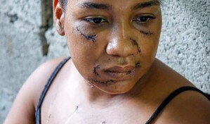 Sobrevivió a 26 estocadas y ahora lucha por sanar las heridas físicas y emocionales