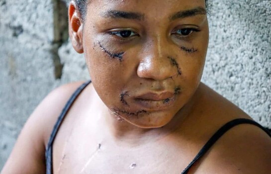 Sobrevivi&oacute; a 26 estocadas y ahora lucha por sanar las heridas f&iacute;sicas y emocionales