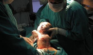 Sociedad de Obstetricia sobre la alta tasa de ces&aacute;reas en RD: "Ha rebasado el l&iacute;mite"