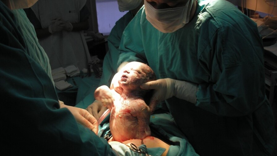 Sociedad de Obstetricia sobre la alta tasa de cesáreas en RD: "Ha rebasado el límite" Sociedad de Obstetricia sobre la alta tasa de cesáreas en RD: "Ha rebasado el límite"