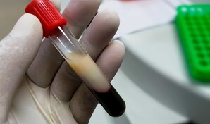 ¿Te suben los triglicéridos por la grasa que comes… o por el arroz, el pan y el jugo?
