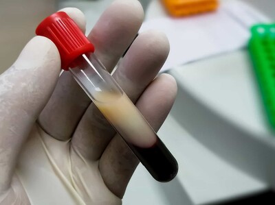 Triglicéridos altos: qué alimentos pueden elevarlos