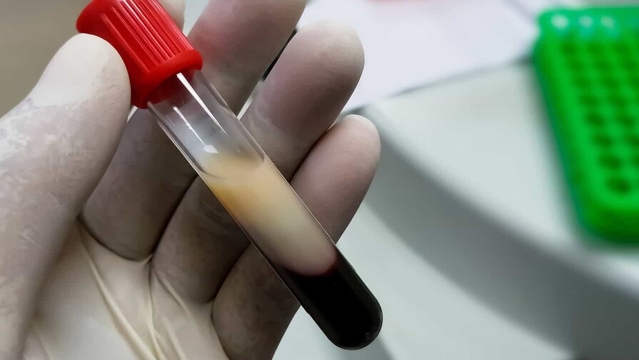 ¿Te suben los triglicéridos por la grasa que comes… o por el arroz, el pan y el jugo? ¿Te suben los triglicéridos por la grasa que comes… o por el arroz, el pan y el jugo?