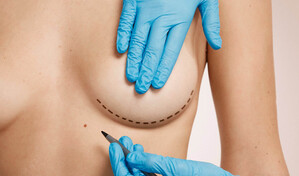 Explantaci&oacute;n mamaria: por qu&eacute; cada vez m&aacute;s mujeres deciden retirar sus implantes
