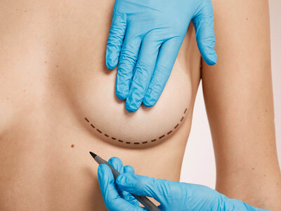Explantación mamaria: por qué es tendencia retirar los implantes