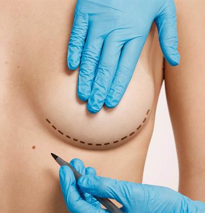 Explantaci&oacute;n mamaria: por qu&eacute; cada vez m&aacute;s mujeres deciden retirar sus implantes
